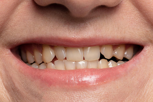 Avoir les dents jaunes