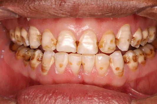 Dents tache marron