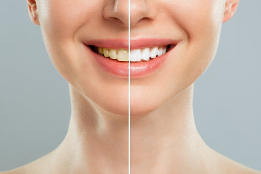 Avant & Après blanchiment dentaire