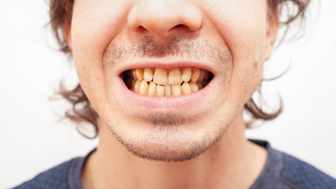 Dents jaunes cause tabac