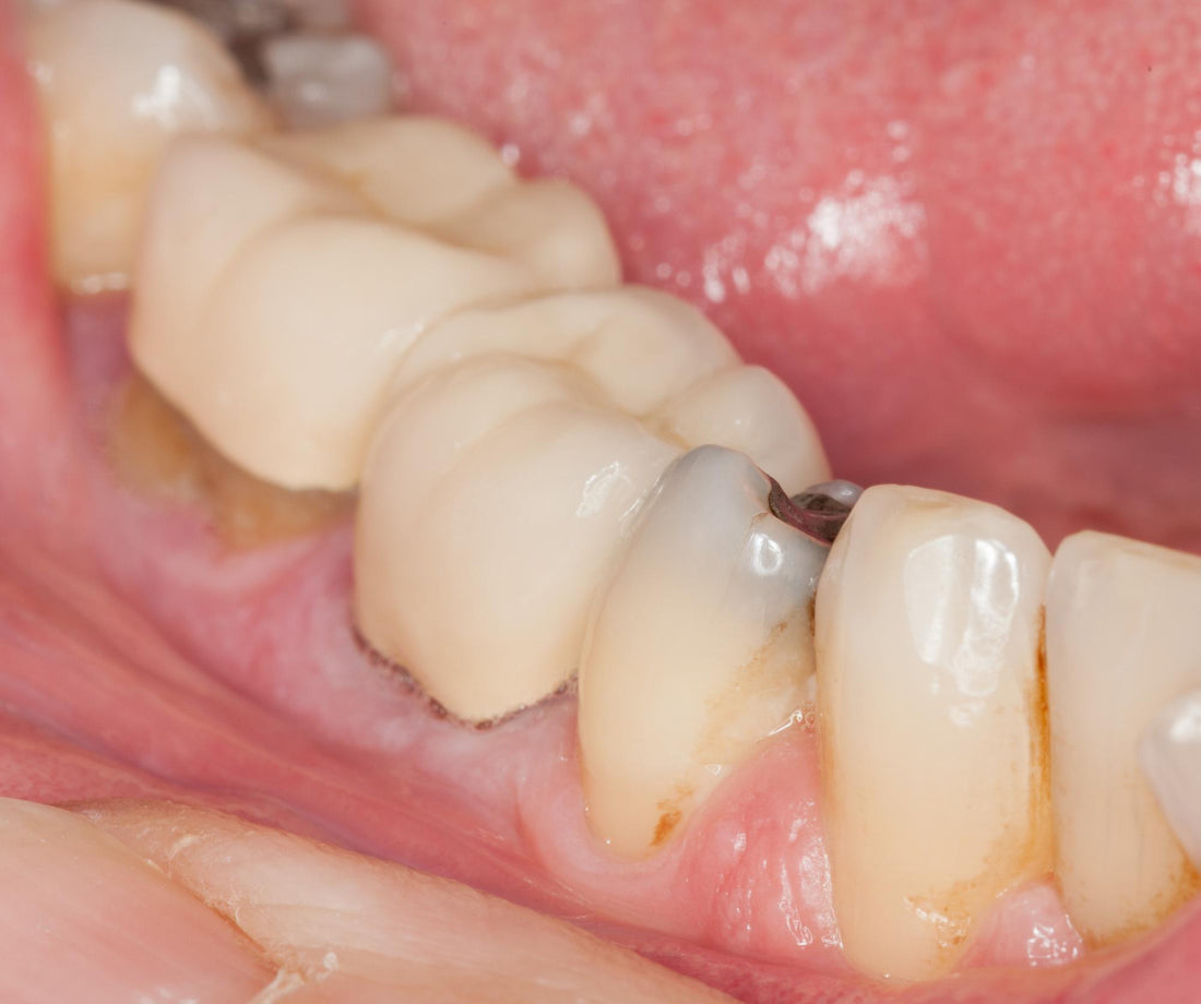 C'est quoi l'érosion dentaire ?