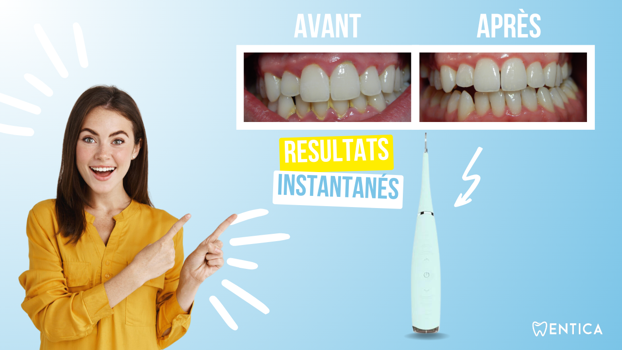 Détartreur dentaire