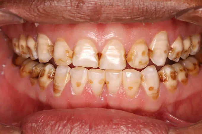 Dents tache marron