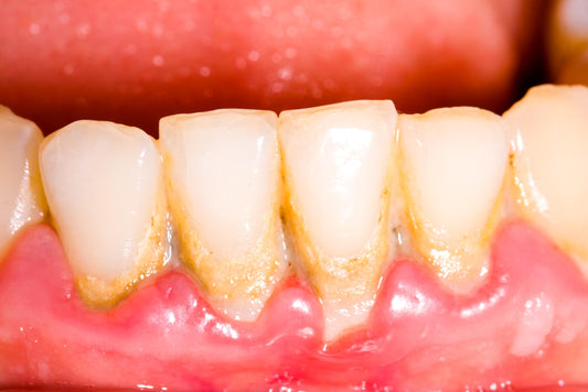 Plaque Dentaire