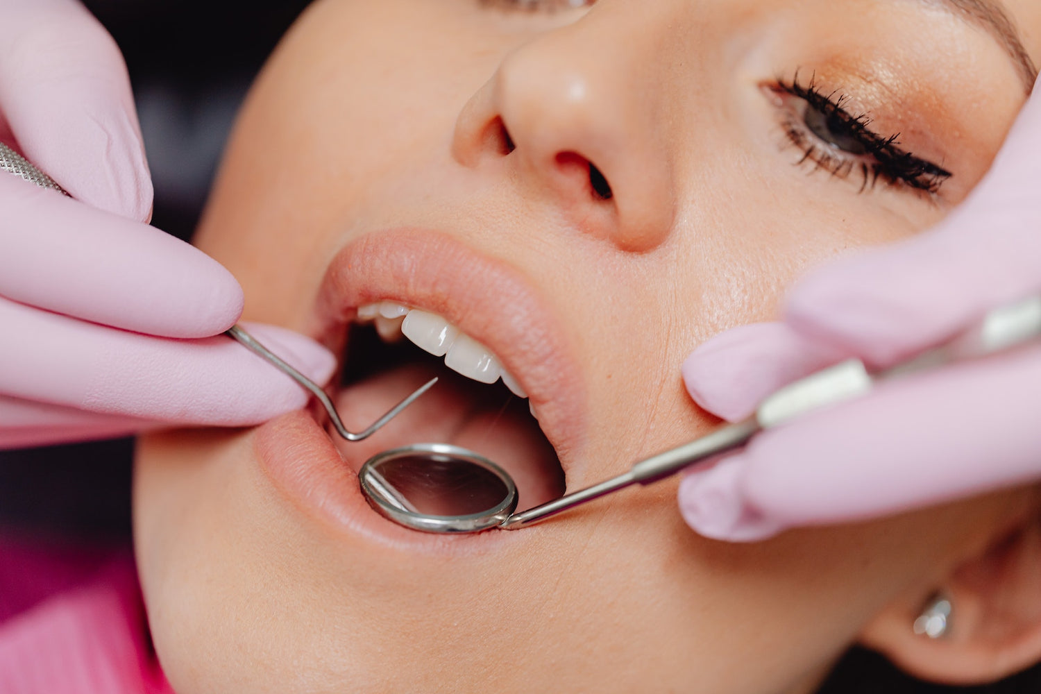 Est-ce que le tartre abîme les dents ?